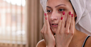 Aceite de árbol del té directamente sobre la piel
