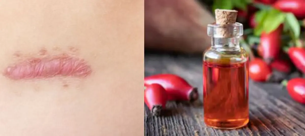 «Bye bye cicatrices: ponle amor y aceite de rosa mosqueta a tu piel»