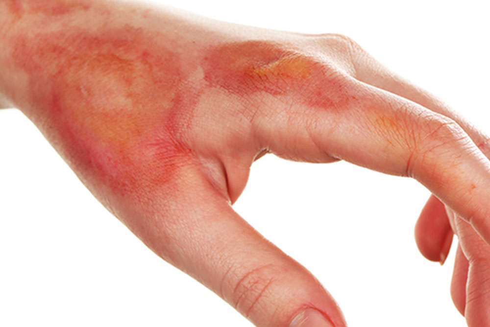 ¡El poder curativo del aceite de hipérico para quemaduras!